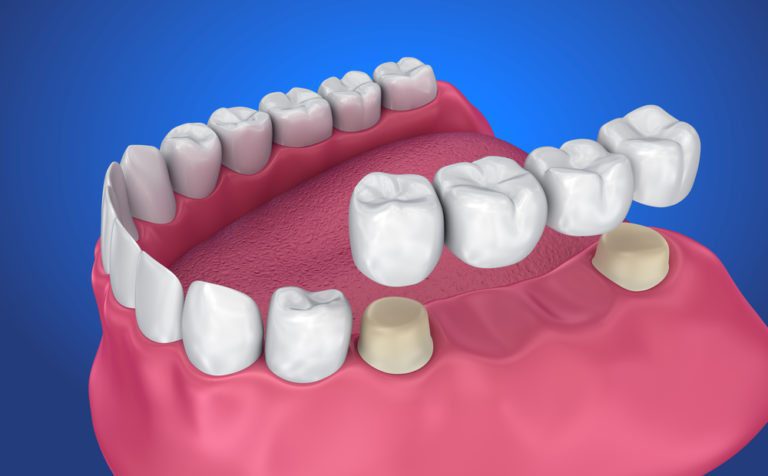 digital image of tooth removal